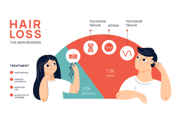 Download Hair Loss Infographic. Male and Female a - Hair loss Collection
