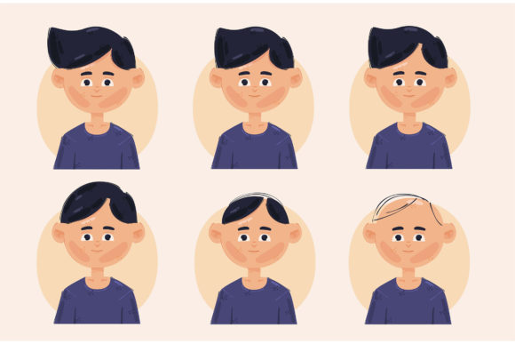 Download Hair Loss Stages Illustration - Hair loss Collection