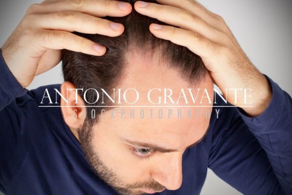 Download Man Controls Hair Loss - Hair loss Collection